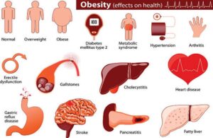 Obesity